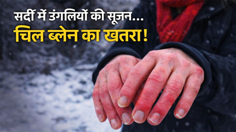 Chil Blain in Winter